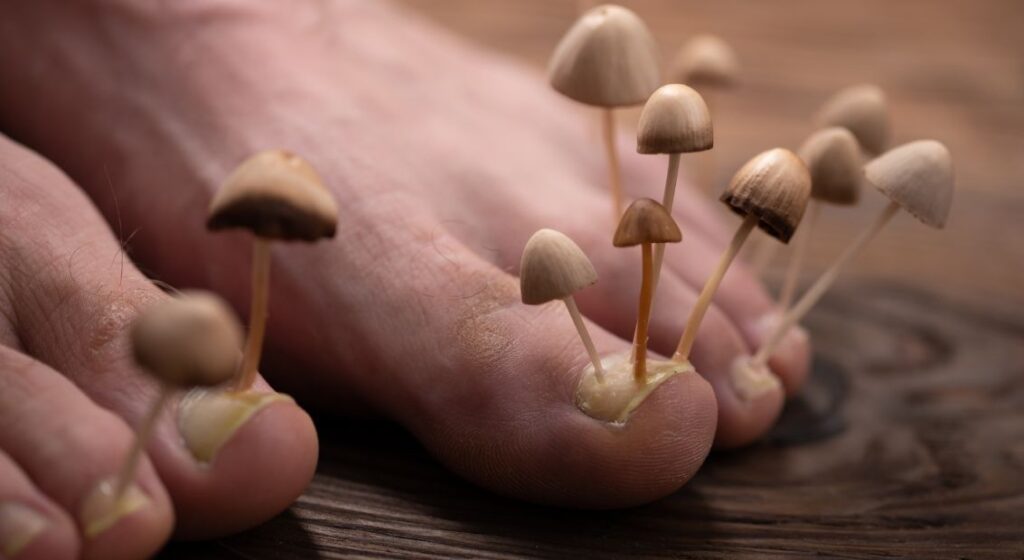 Toenail fungus, also known as onychomycosis, is an infection caused by fungi.